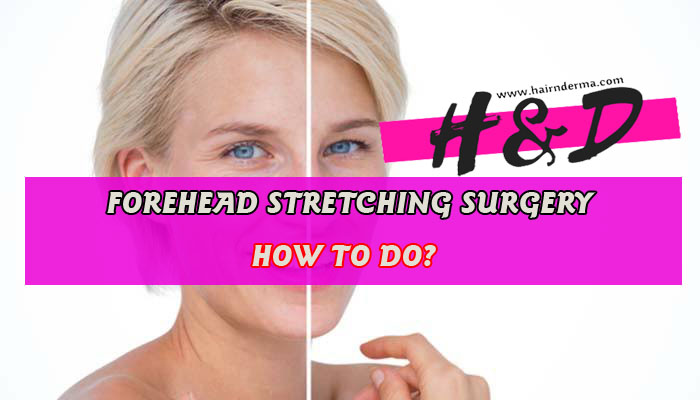 How is the forehead stretching surgery