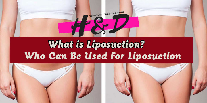 what is liposuction