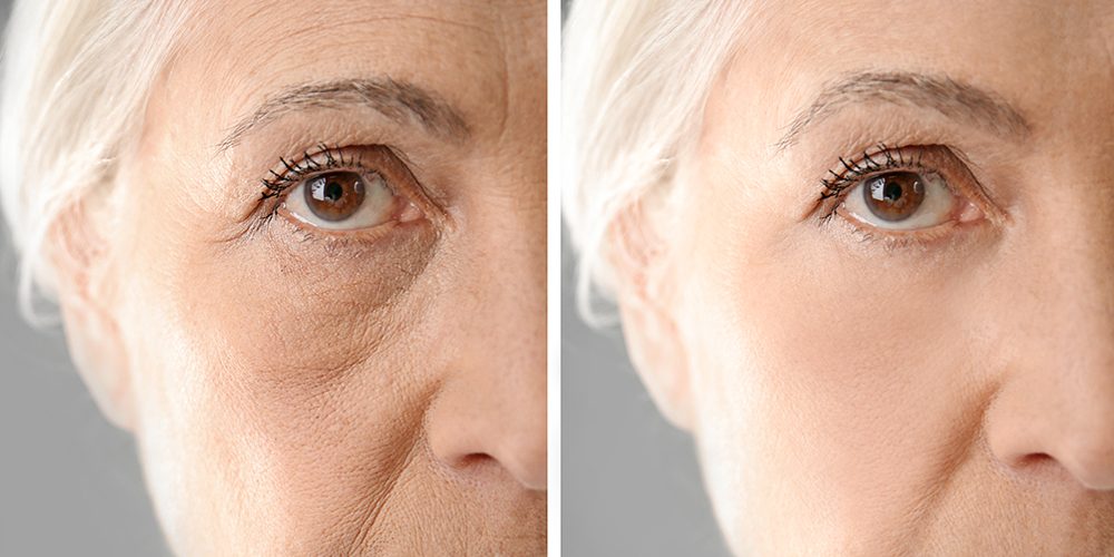 mid-face lift surgery