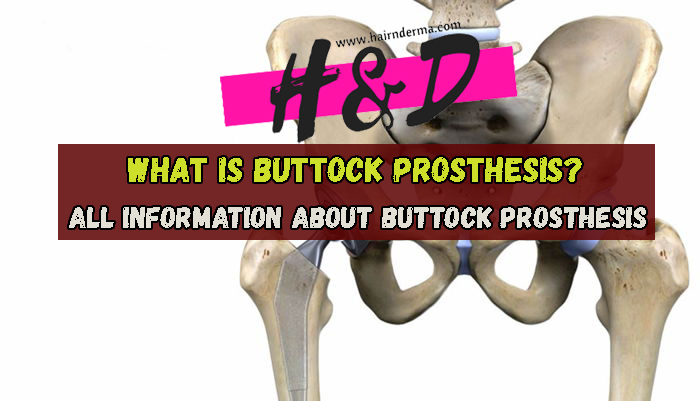 what is buttock prosthesis