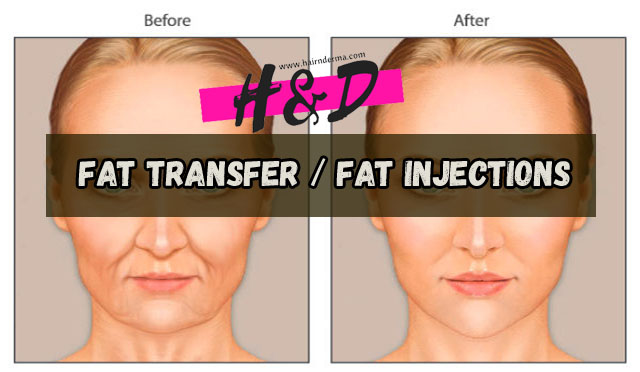 fat transfer