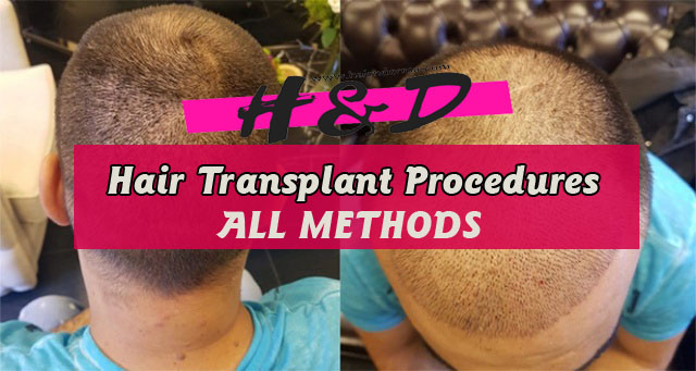Hair Transplant Procedures