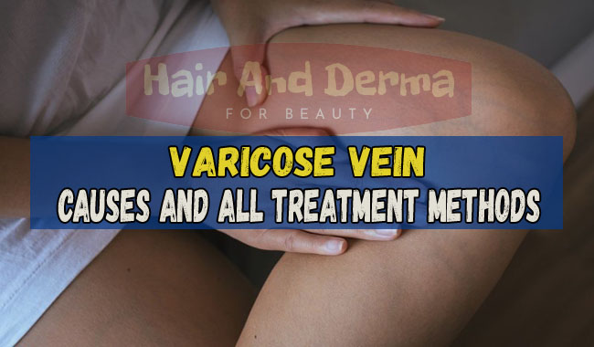 causes varicose vein