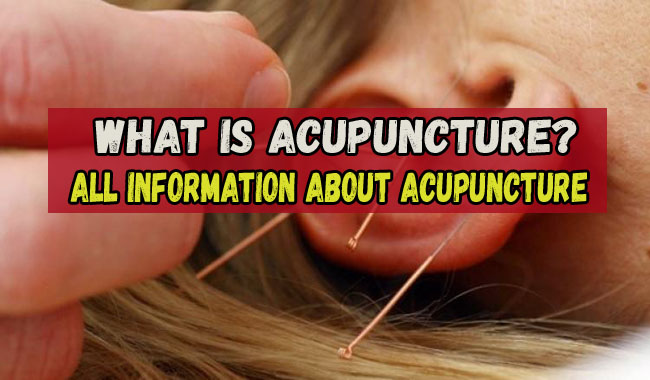 acupuncture benefits